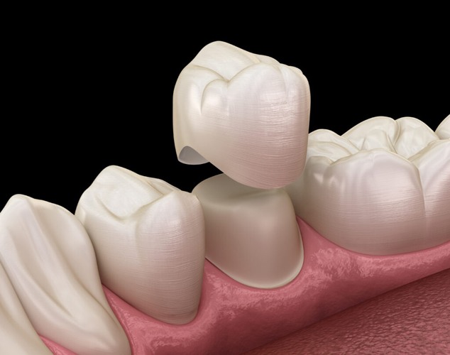 Dental crown premolar tooth assembly process. Medically accurate