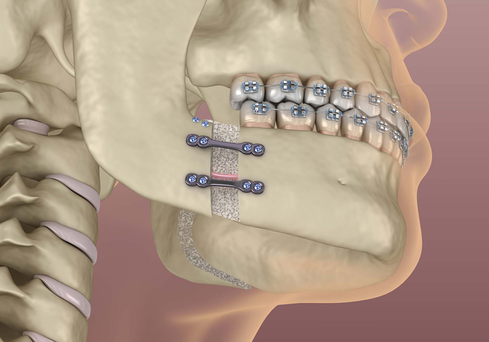 Mandibular Advancement surgery. Medically accurate dental 3D ill