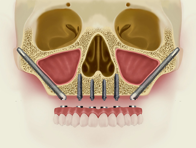 zigomatik-implant (1)