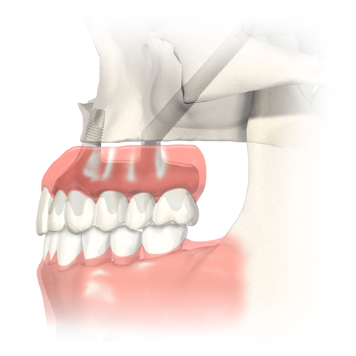 zigomatik-implant (2)