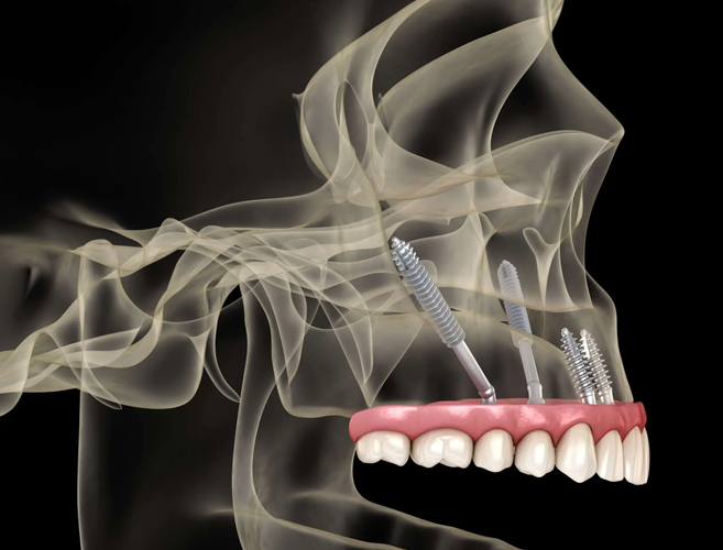 zigomatik-implant (4)