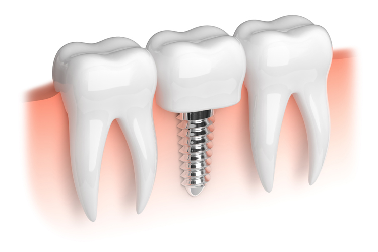 Zygomatic Implants For Severe Bone Loss – 1